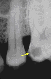 Radiographie d'une carie