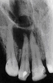 Radiographie du stade ultime
